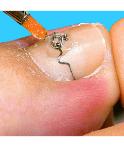 Szkolenie Klamry Na Wrastające Paznokcie