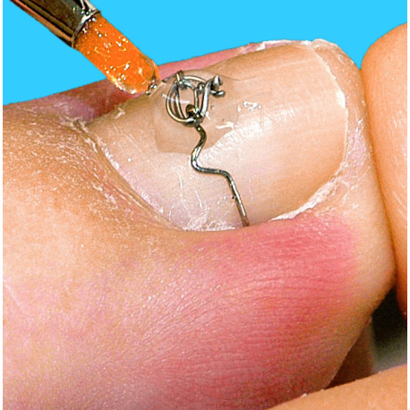 Szkolenie Klamry Na Wrastające Paznokcie