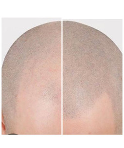 Szkolenie MIKROPIGMENTACJA SKÓRY GŁOWY