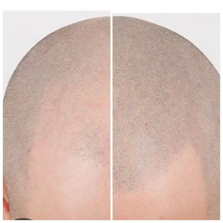 Szkolenie MIKROPIGMENTACJA SKÓRY GŁOWY